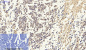 Immunohistochemical analysis of paraffin-embedded Human-lung-cancer tissue. 1, Smad3 Polyclonal Antibody was diluted at 1:200 (4°C, overnight). 2, Sodium citrate pH 6.0 was used for antibody retrieval (>98°C, 20min). 3, Secondary antibody was diluted at 1:200 (room tempeRature, 30min). Negative control was used by secondary antibody only.