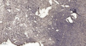 Immunohistochemical analysis of paraffin-embedded human oophoroma. 1, Antibody was diluted at 1:200 (4°C overnight). 2, STJ95749
