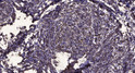 Immunohistochemical analysis of paraffin-embedded human breast cancer. 1, Antibody was diluted at 1:200 (4° overnight). STJ95799