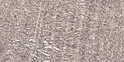 Immunohistochemical analysis of paraffin-embedded human small intestinal carcinoma tissue. 1, Primary antibody was STJ95829
