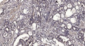 Immunohistochemical analysis of paraffin-embedded human gastric adenocarcinoma. 1, Antibody was diluted at 1:200 (4°C STJ95831
