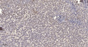 Immunohistochemical analysis of paraffin-embedded human liver cancer. 1, Antibody was diluted at 1:200 (4° overnight). STJ95868