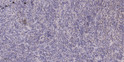 Immunohistochemical analysis of paraffin-embedded human colon cancer. 1, Antibody was diluted at 1:200 (4° overnight). STJ96009