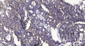 Immunohistochemical analysis of paraffin-embedded human gastric adenocarcinoma. 1, Antibody was diluted at 1:200 (4°C STJ96080