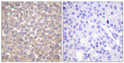 Immunohistochemistry analysis of paraffin-embedded human breast carcinoma tissue, using TRADD Antibody. The picture on the right is blocked with the synthesized peptide.