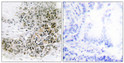 Immunohistochemistry analysis of paraffin-embedded human lung carcinoma tissue, using TRPS1 Antibody. The picture on the right is blocked with the synthesized peptide.