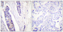 Immunohistochemistry analysis of paraffin-embedded human breast carcinoma tissue using Tubulin beta Antibody. The STJ96145