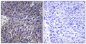 Immunohistochemistry analysis of paraffin-embedded human lung carcinoma tissue, using USP50 Antibody. The picture on the right is blocked with the synthesized peptide. Immunohistochemistry analysis of paraffin-embedded human lung carcinoma tissue, using USP50 Antibody. The picture on the right is blocked with the synthesized peptide.