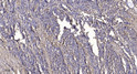 Immunohistochemical analysis of paraffin-embedded human gastric adenocarcinoma. 1, Antibody was diluted at 1:200 (4° STJ96270