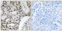 Immunohistochemistry analysis of paraffin-embedded human breast carcinoma tissue, using ZMYM4 Antibody. The picture on STJ96324