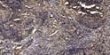 Immunohistochemical analysis of paraffin-embedded human squamous cell carcinoma of the lung. 1, Antibody was diluted at STJ96351