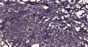 Immunohistochemical analysis of paraffin-embedded human breast cancer. 1, Antibody was diluted at 1:200 (4° overnight). STJ96362