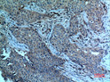 Immunohistochemical analysis of paraffin-embedded human-breast-cancer, antibody was diluted at 1:100