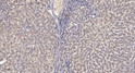 Immunohistochemical analysis of paraffin-embedded human liver cancer. 1, Antibody was diluted at 1:200 (4° overnight). STJ96572