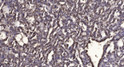 Immunohistochemical analysis of paraffin-embedded human liver cancer. 1, Antibody was diluted at 1:200 (4° overnight). STJ96660