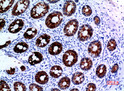 Immunohistochemical analysis of paraffin-embedded human-colon, antibody was diluted at 1:100