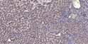 Immunohistochemical analysis of paraffin-embedded human liver cancer. 1, Antibody was diluted at 1:200 (4° overnight). STJ96701