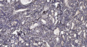 Immunohistochemical analysis of paraffin-embedded human gastric adenocarcinoma. 1, Antibody was diluted at 1:200 (4°C STJ96712