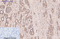 Immunohistochemical analysis of paraffin-embedded Human-liver-cancer tissue. 1, CD5 monoclonal antibody (10G8) was diluted at 1:200 (4°C, overnight). 2, Sodium citrate pH 6.0 was used for antibody retrieval (>98°C, 20min). 3, Secondary antibody was diluted at 1:200 (room tempeRature, 30min). Negative control was used by secondary antibody only.