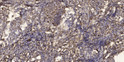 Immunohistochemical analysis of paraffin-embedded human squamous cell carcinoma of the lung. 1, Antibody was diluted at STJ97291