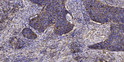 Immunohistochemical analysis of paraffin-embedded human squamous cell carcinoma of lung. 1, Antibody was diluted at STJ97342