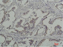 Immunohistochemical analysis of paraffin-embedded human breast carcinoma using Phosphotyrosine Mouse mAb diluted at STJ97487