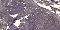 Immunohistochemical analysis of paraffin-embedded human cervical carcinoma. 1, Antibody was diluted at 1:200 (4° STJ97699