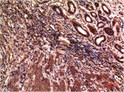 Immunohistochemical analysis of paraffin-embedded Human Breast Carcinoma Tissue using Gamma Tubulin Mouse mAb diluted at 1:200.