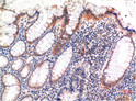 Immunohistochemical analysis of paraffin-embedded human colon carcinoma tissue using Phospho-MLKL S358 Mouse mAb STJ97776