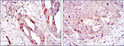 Immunohistochemistry analysis of paraffin-embedded ovarian cancer (left) and lung cancer (right) with DAB staining using ARK-1 monoclonal antibody.