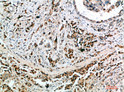 Immunohistochemical analysis of paraffin-embedded human-breast-cancer, antibody was diluted at 1:200