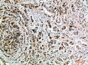 Immunohistochemical analysis of paraffin-embedded human-breast-cancer, antibody was diluted at 1:200