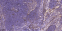 Immunohistochemical analysis of paraffin-embedded human cervical carcinoma. 1, Antibody was diluted at 1:200 (4° STJ98658