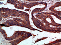 Immunohistochemical analysis of paraffin-embedded human-colon-cancer, antibody was diluted at 1:200