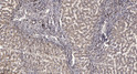Immunohistochemical analysis of paraffin-embedded human liver cancer. 1, Antibody was diluted at 1:200 (4° overnight). STJ98847