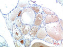 Immunohistochemical analysis of paraffin-embedded Human Thyroid Tissue using TTR Mouse mAb diluted at 1:200 Immunohistochemical analysis of paraffin-embedded Human Thyroid Tissue using TTR Mouse mAb diluted at 1:200