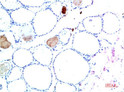 Immunohistochemical analysis of paraffin-embedded Human Liver Carcinoma Tissue using TTR Mouse mAb diluted at 1:200