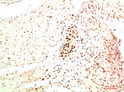 Immunohistochemical analysis of paraffin-embedded Human Colon Carcinoma Tissue using HP-1 Alpha Mouse mAb diluted at 1:200