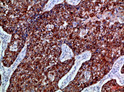 Immunohistochemical analysis of paraffin-embedded Human-lung-cancer, antibody was diluted at 1:100