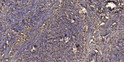 Immunohistochemical analysis of paraffin-embedded human squamous cell carcinoma of the lung. 1, Antibody was diluted at STJ99342