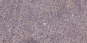 Immunohistochemical analysis of paraffin-embedded human colon cancer. 1, Antibody was diluted at 1:200 (4° overnight). STJ99595