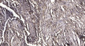 Immunohistochemical analysis of paraffin-embedded human squamous cell carcinoma of lung. 1, Antibody was diluted at STJ99648