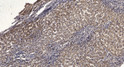 Immunohistochemical analysis of paraffin-embedded human liver cancer. 1, Antibody was diluted at 1:200 (4° overnight). STJ99650