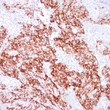 Human angiosarcoma stained with anti-CD31 antibody using peroxidase-conjugate and DAB chromogen. Note cytoplasmic staining of tumor cells.