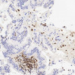 Human pancreatic ductal adenocarcinoma stained with anti-DPC4 (SMAD4) antibody using peroxidase-conjugate and DAB chromogen. Note absence of tumor cell staining while the non-tumor cells are positive.