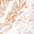 Human colon adenocarcinoma stained with anti-MUC-2 antibody using peroxidase-conjugate and DAB chromogen. Note the cytoplasmic staining of tumor cells.