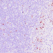 Human colon carcinoma stained with anti-thymidylate synthase (TS) antibody using peroxidase-conjugate and DAB chromogen. Note the cytoplasmic staining of tumor cells.
