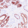 Anti-AMACR + p63 antibody IHC Human prostate carcinoma STJ180269