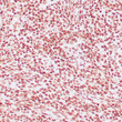 Anti-TLE1 antibody IHC Human synovial sarcoma STJ180329