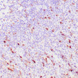 Human spleen involved by hairy cell leukemia stained with anti-TRAcP antibody using peroxidase-conjugate and DAB chromogen. Note the cytoplasmic staining of leukemia cells.